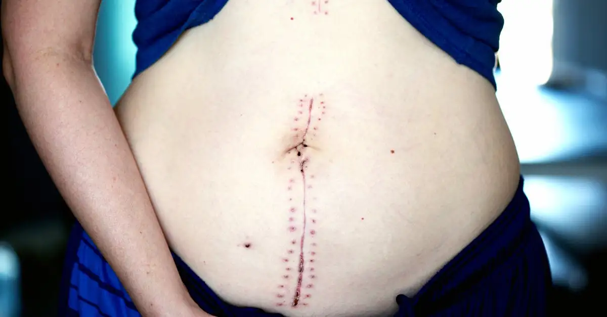 ¿Cómo eliminar la acumulación de líquido en el abdomen post-operatorio?