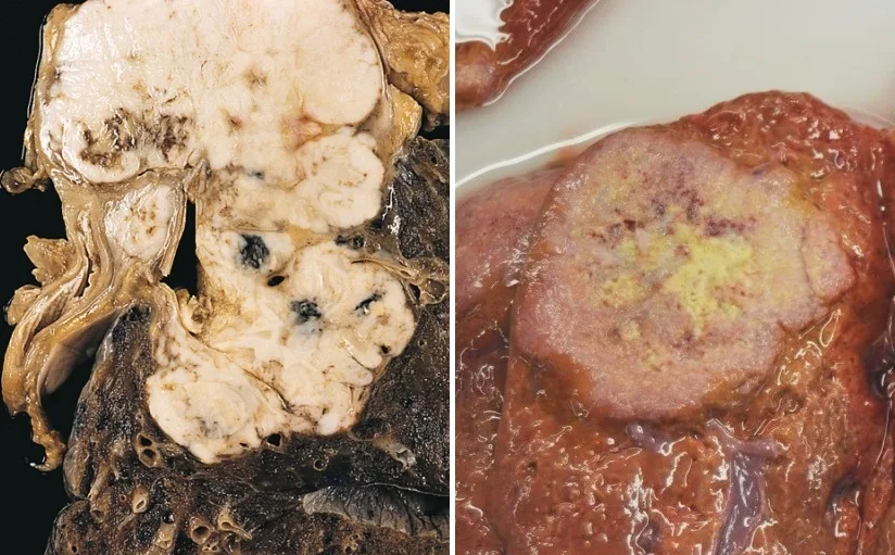 Tumor